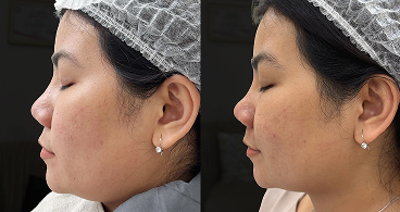 Lippo Face Treatment