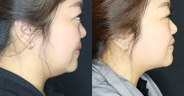 Before After Radio Frequency Face Area Treatment